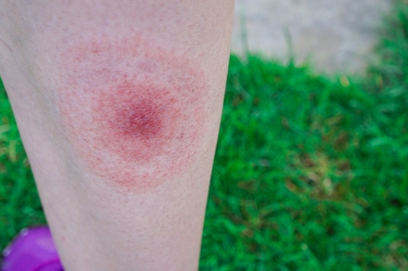 Lyme disease bullseye