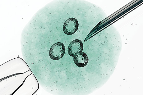 A photographic representation of egg retrieval as part of the in vitro fertilization (IVF) process.