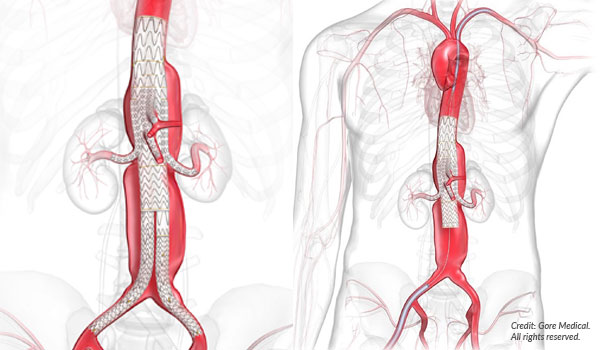 The TAMBE procedure is light years ahead of traditional surgery for thoracoabdominal aortic aneurysms